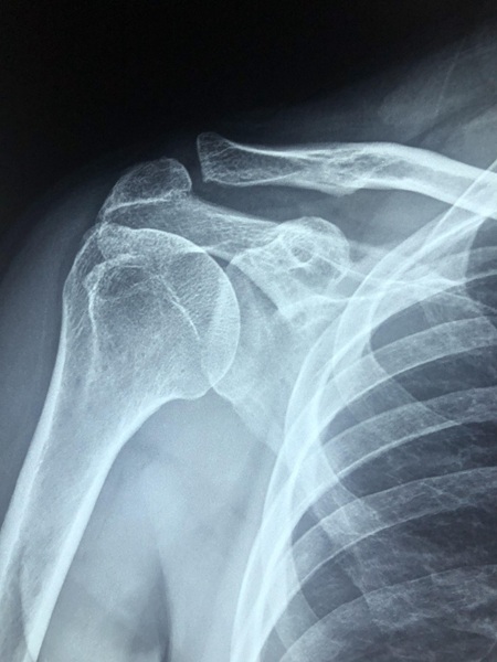 les blessures des batteurs